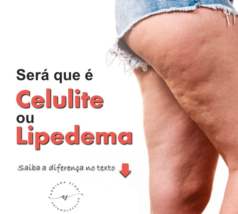 lipedema ou celulite